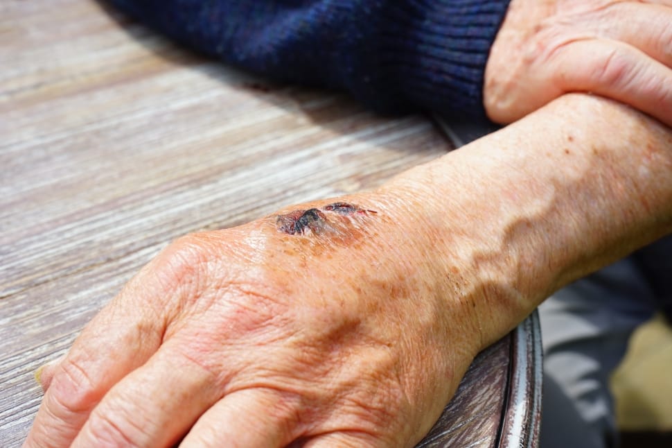 Skin Disorders in Elderly Adults